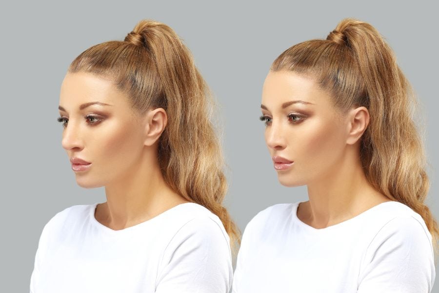 Nâng mũi bán cấu trúc là gì? Ưu điểm nâng mũi bán cấu trúc 9 Nâng mũi bán cấu trúc giúp tạo nên một dáng mũi tự nhiên và mềm mại