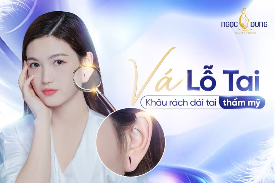 Tiểu phẫu vá lỗ tai nhằm khôi phục tình trạng dái tai bị giãn rộng, bị rách