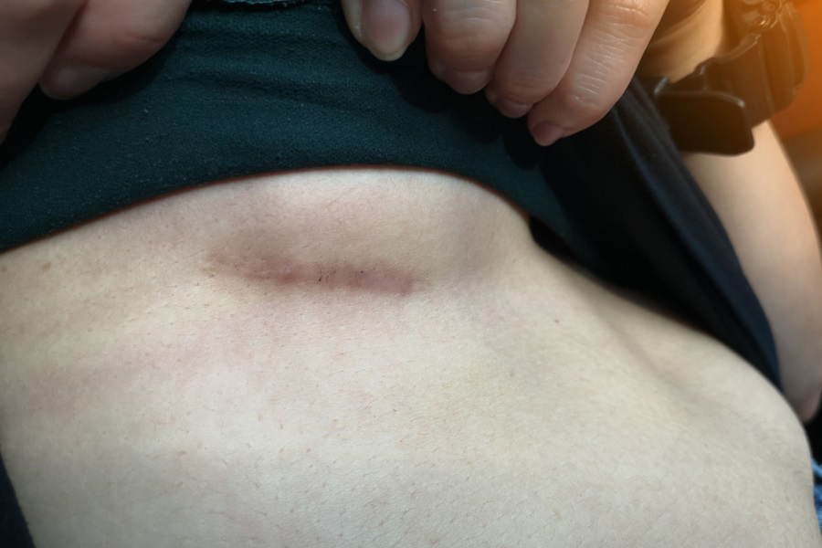 Biến chứng thường gặp nhất là để lại một vết xấu dưới chân ngực 