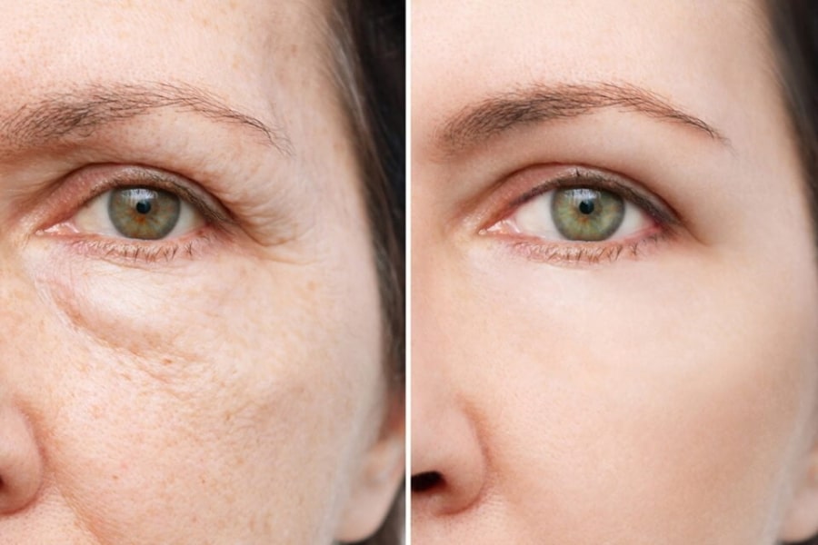 Căng da mặt có tác dụng gì?