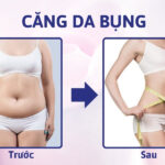 Có nên phẫu thuật căng da bụng chảy xệ không? Giá bao nhiêu?