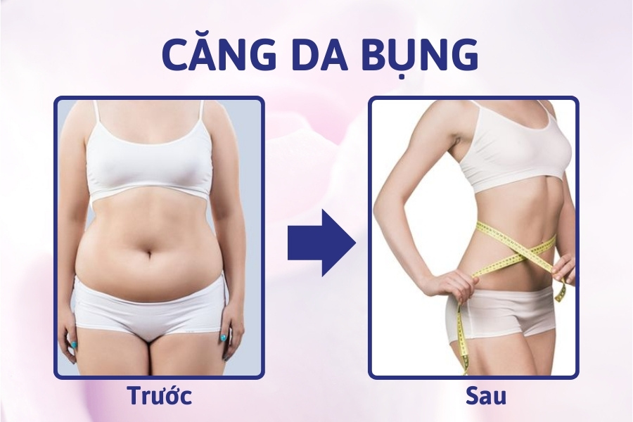 Có nên phẫu thuật căng da bụng chảy xệ không? Giá bao nhiêu?