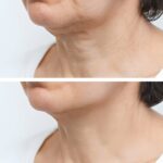 Căng da cổ - Giải pháp vàng cho làn da nhăn nheo, chảy xệ