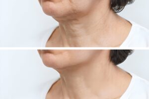 Căng da cổ - Giải pháp vàng cho làn da nhăn nheo, chảy xệ