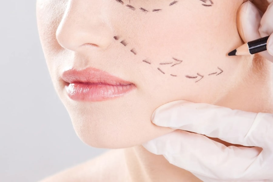 Căng da mặt tiểu phẫu (Căng da nội soi)