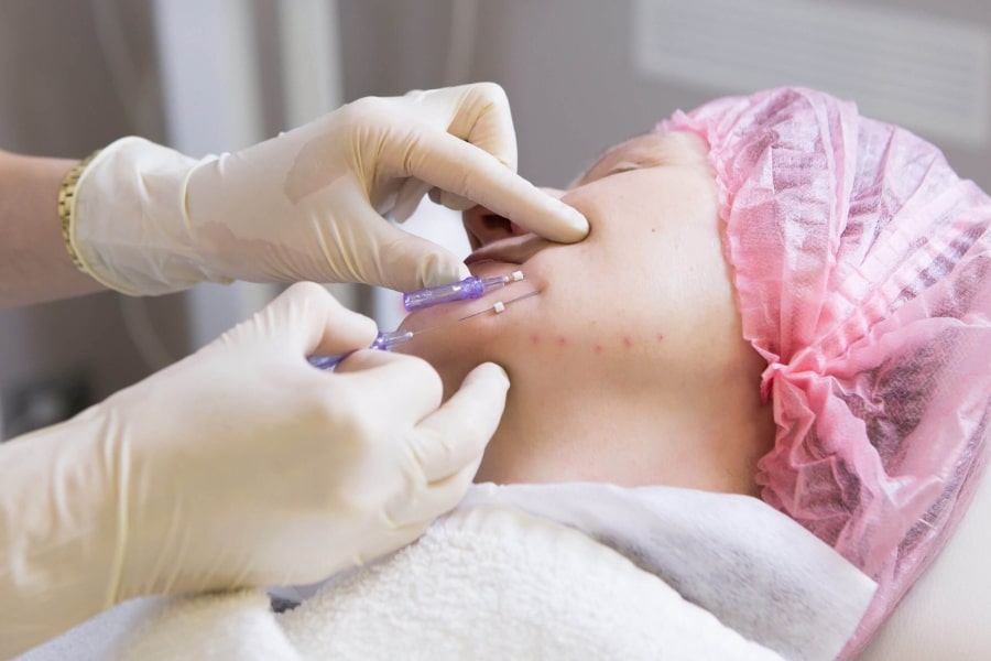 Căng chỉ da mặt như thế nào? Có nên căng chỉ mặt?