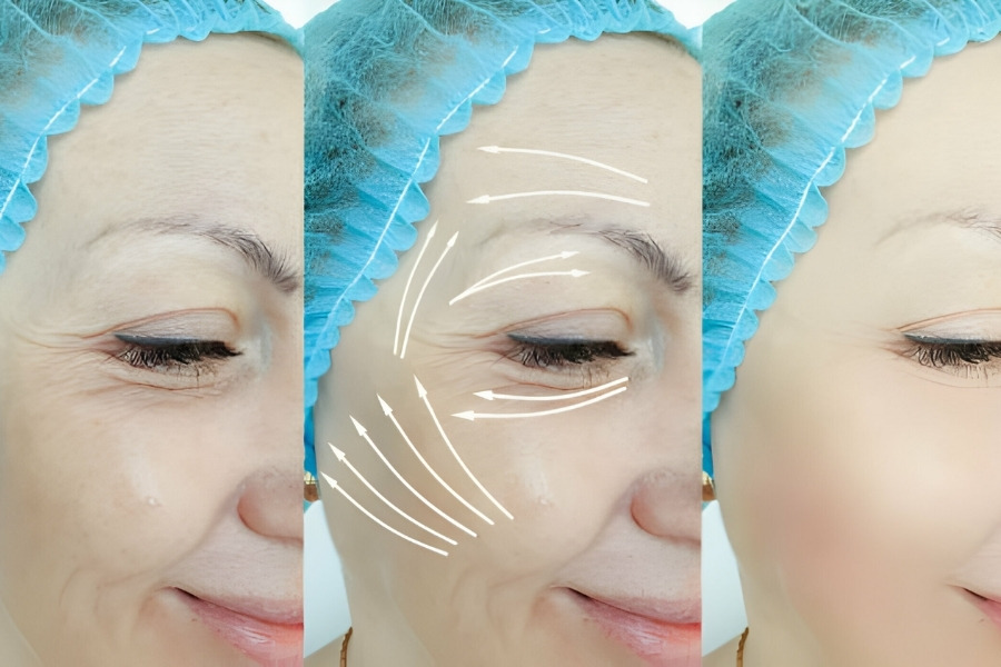 Căng da ở vùng thái dương là phương pháp thẩm mỹ giúp cải thiện tình trạng lão hóa xuất hiện ở vùng thái dương