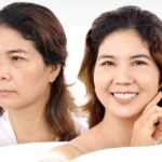 Căng da thái dương là gì? Có tác dụng gì? Giá bao nhiêu?