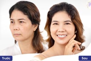 Căng da thái dương là gì? Có tác dụng gì? Giá bao nhiêu?