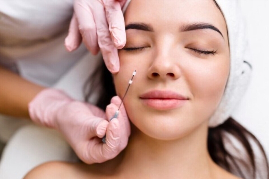 Căng da trán bằng chỉ sử dụng chỉ sinh học để kích thích quá trình sản xuất collagen