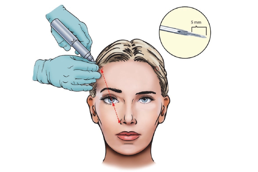 Căng da trán nội soi sử dụng thiết bị nội soi để loại bỏ da chùng và định vị lại mô