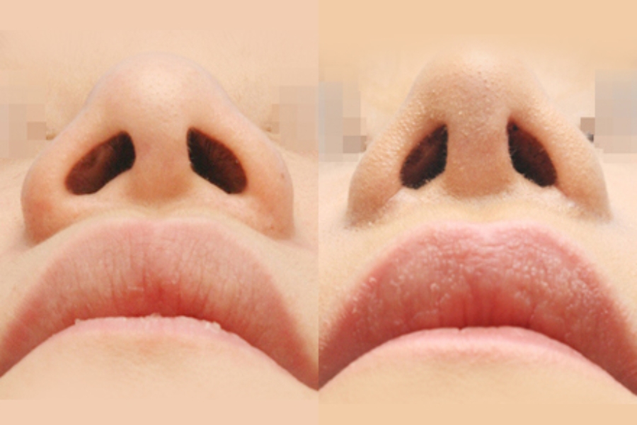 Những ai không nên làm phẫu thuật thu gọn cánh mũi?