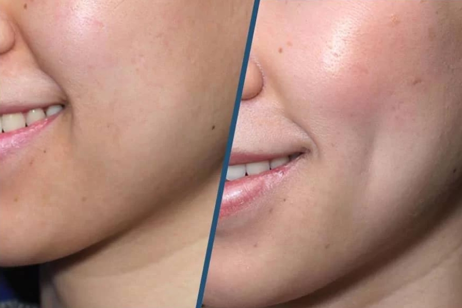 hình ảnh trước và sau thực hiện cắt đồng tiền, đồng điếu