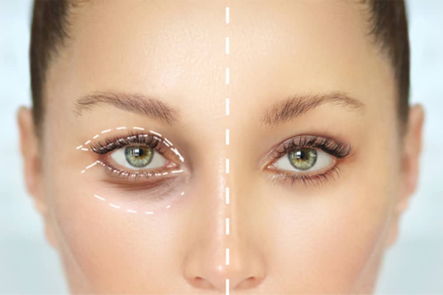 Cắt mí tạo đường mí sắc sảo và giảm bọng mắt