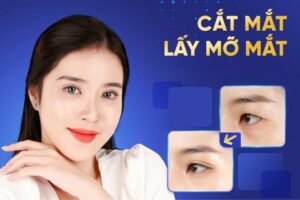 Cắt mí là gì? Có nên cắt mắt 2 mí không? Cắt mí ở đâu đẹp?