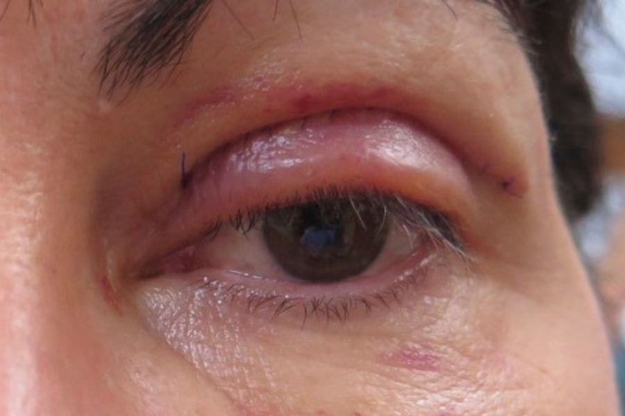 Mắt bị bầm tím sau khi cắt mắt