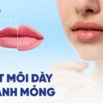 Có nên phẫu thuật thẩm mỹ cắt môi dày thành mỏng không?