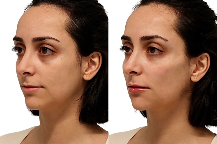 Cấy mỡ thái dương bao lâu thì đẹp?