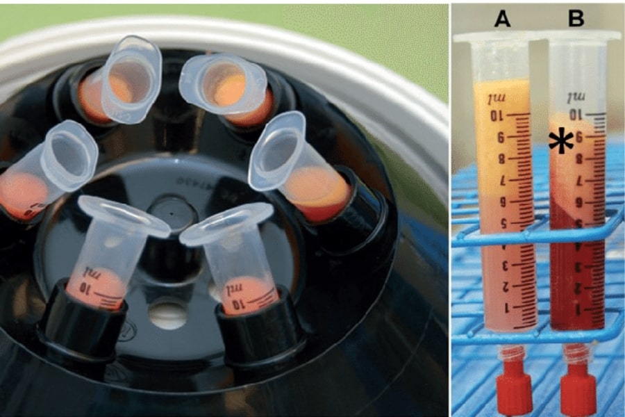 Ưu điểm của phương pháp làm đầy thái dương bằng mỡ tự thân