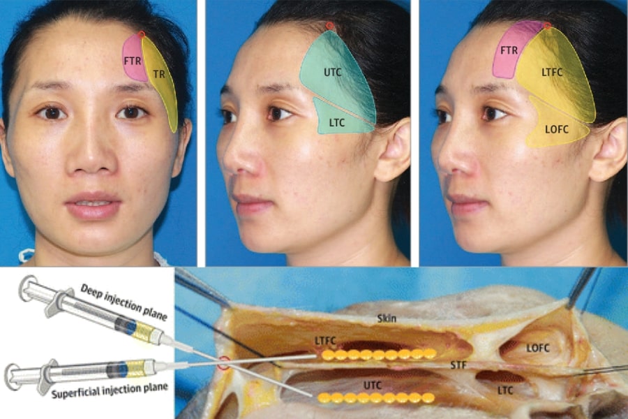 Đối tượng nào phù hợp với phương pháp cấy mỡ thái dương