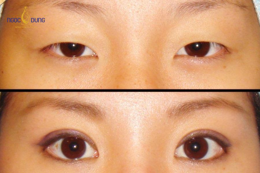 Phẫu thuật cắt mí mắt là gì? Có nên cắt mắt 2 mí không? 8 Chuyên gia giải đáp thắc mắc có nên cắt mí mắt không dựa trên tình trạng khuyết điểm thực tế