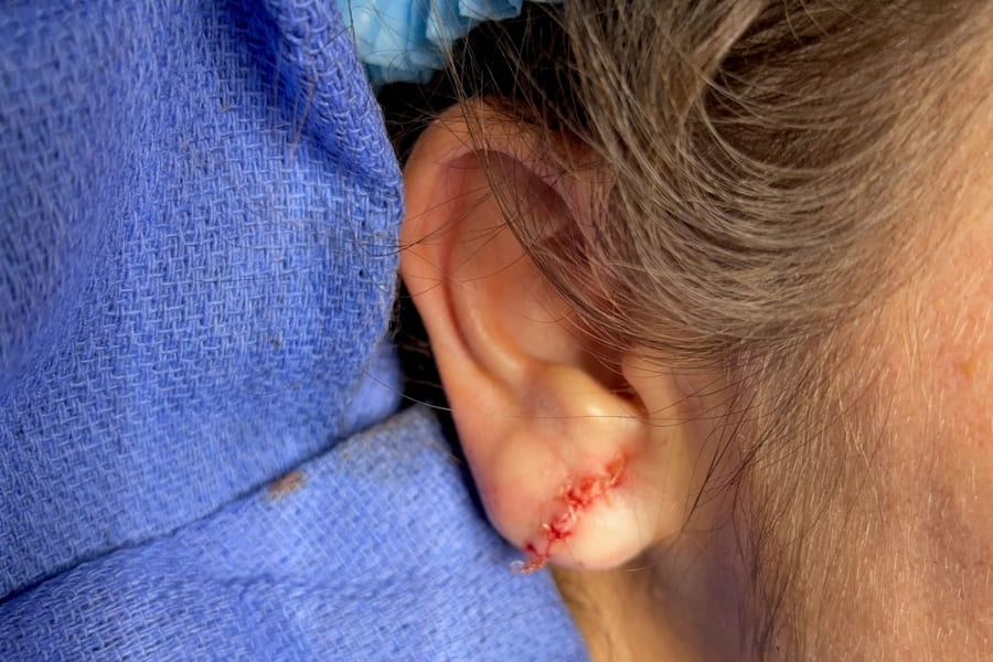 Phương pháp vá lỗ tai với tiểu phẫu đặt nếp tròn