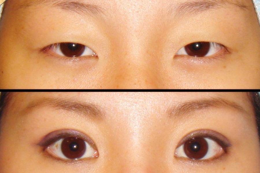 Người có mắt một mí nên cắt mí mắt