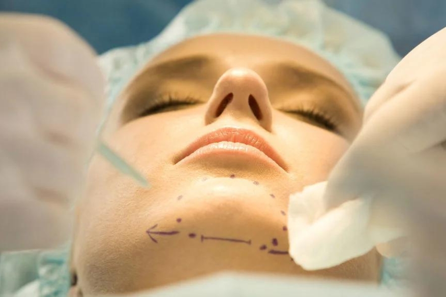 Độn cằm V line là gì