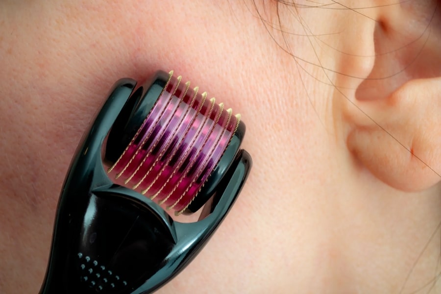 Phương pháp lăn kim, tái tạo da