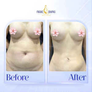 giam mo bung hieu qua