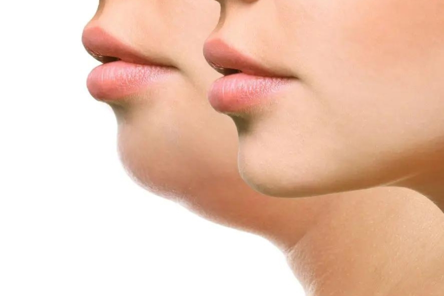 Hút mỡ nọng cằm mang lại khuôn mặt thon gọn, đường nét rõ ràng hơn