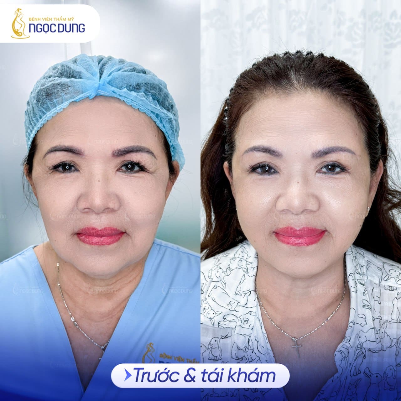 Nâng cung chân mày là gì? Có nên nâng cung chân mày không? 16 Kết quả nâng cung chân mày thực tế tại Bệnh viện Thẩm mỹ Ngọc Dung