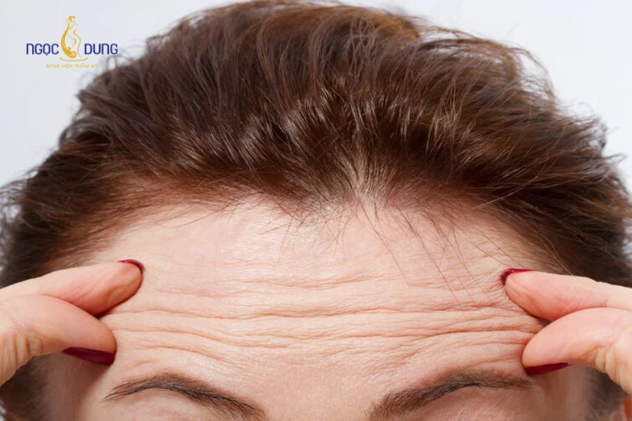 Phẫu thuật căng da trán có đau không? Những ai nên thực hiện? 7 Khách hàng có nếp nhăn trán sâu được bác sĩ thăm khám chỉ định