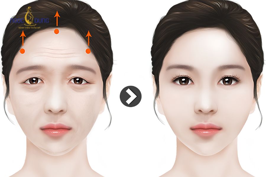 Phẫu thuật căng da trán có đau không? Những ai nên thực hiện? 6 Kỹ thuật can thiệp mô mềm vùng trán giúp trẻ hóa tầng mặt trên