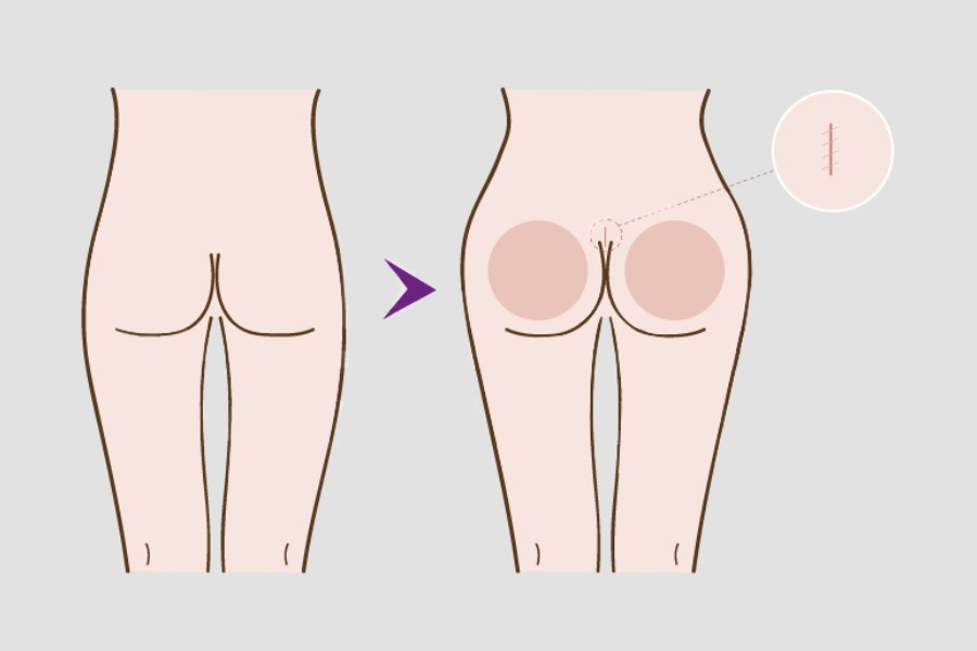 Kỹ thuật nâng mông bằng túi độn