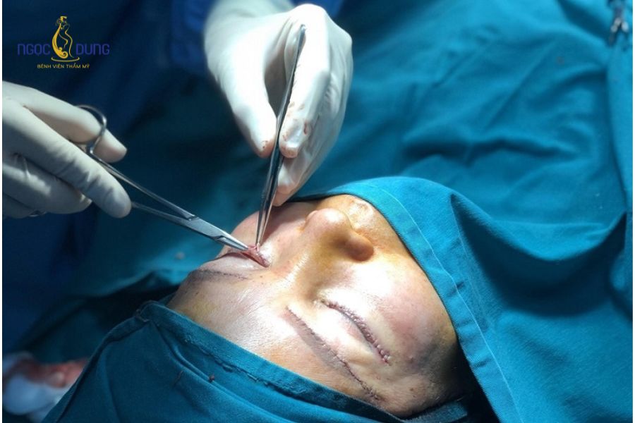 Nâng cung chân mày là gì? Có nên nâng cung chân mày không? 13 Kỹ thuật phẫu thuật treo chân mày giúp cắt bỏ triệt để phần da dư thừa bám sâu ở bầu mắt