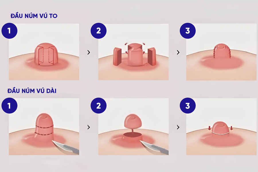 kỹ thuật thi nhỏ đầu ti