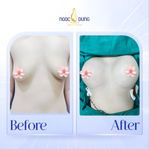 Nâng cấp ngực nhỏ, không cân đối