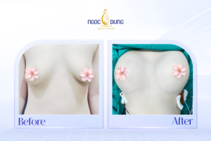 nang cap nguc nho khong deu