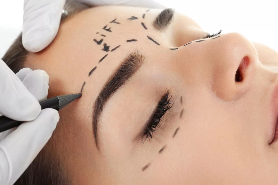 Nâng chân mày là gì? Nâng chân mày là loại bỏ da và mỡ thừa ở cung mày