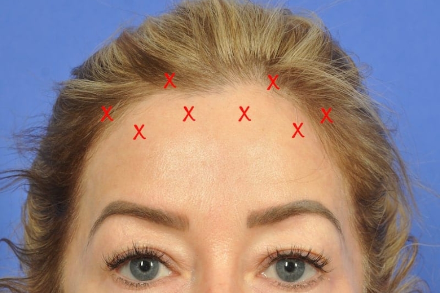 Nâng tầm nhan sắc, níu giữ thanh xuân với bí quyết Nâng cung chân mày nội soi