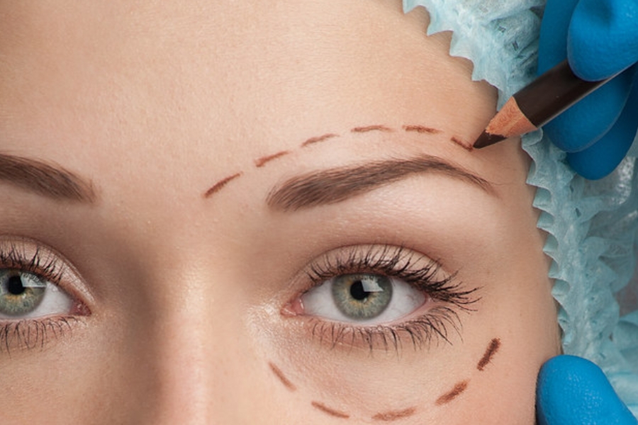 Nâng cung chân mày cần 5 ngày để thấy hết sưng rõ rệt