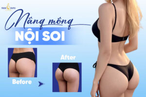 Tìm hiểu về nâng mông nội soi bao nhiêu tiền và những điều cần biết
