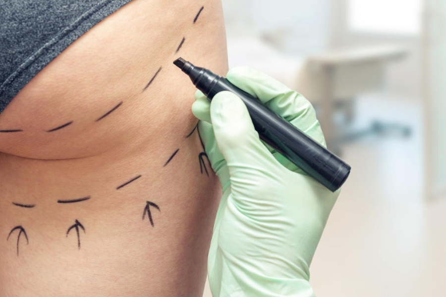 Nâng vòng 3 nội soi có khoảng 120 triệu đồng