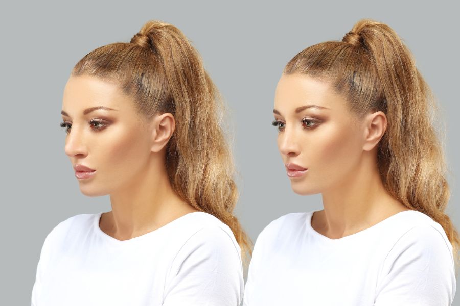 nâng mũi bán cấu trúc giá bao nhiêu