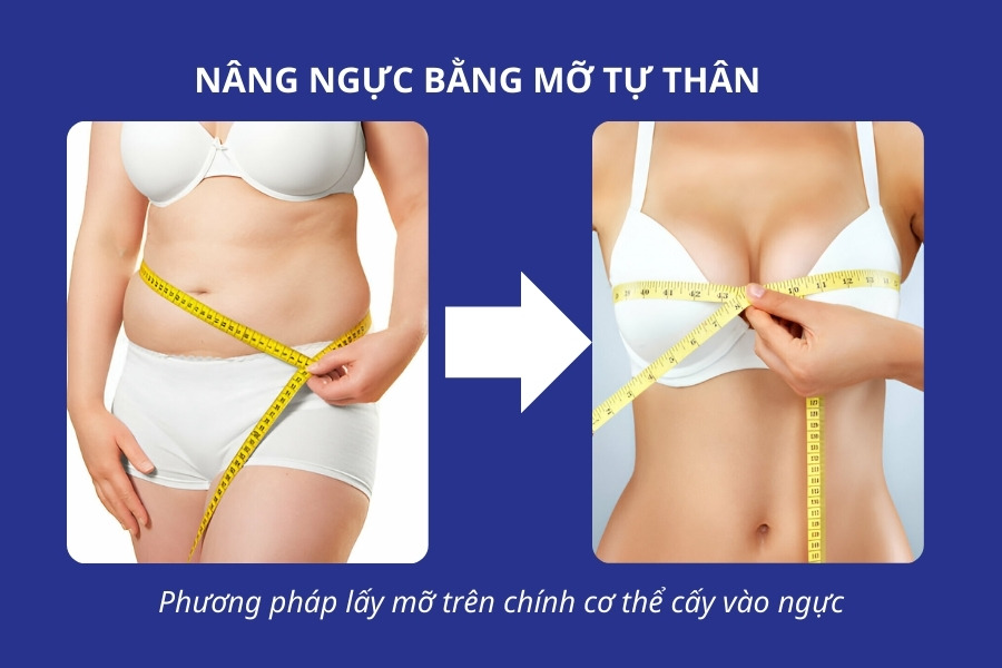 Nâng mỡ bằng tự thân sử dụng tế bào mỡ trên cơ thể để cấy và cải thiện vòng 1