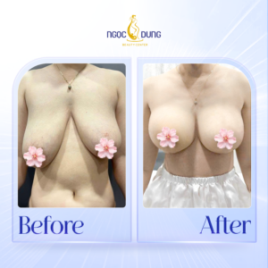 Nâng vòng ngực bị chạy xệ