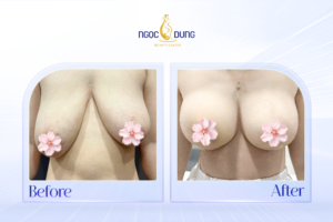 Vòng 1 căng tròn sau khi nâng ngực chảy xệ thành công