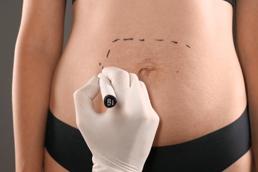 Phương pháp nâng vong 1 nội soi qua đường rốn