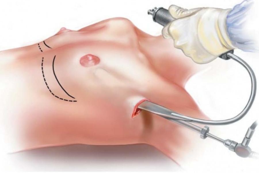 Phương pháp nâng ngực nội soi qua đường hố nách